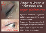 Лазерне видалення татуажу