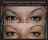 Лазерне видалення татуажу