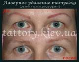 Лазерне видалення татуажу