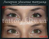Лазерне видалення татуажу